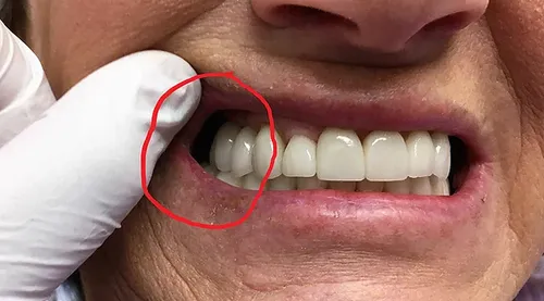 Before: Smile transformation — dental implants