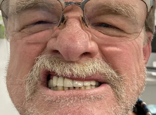 After: Smile transformation — crowns and implants