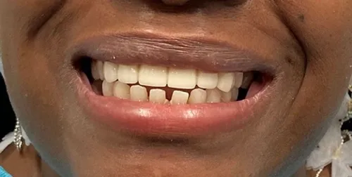 After: Smile transformation — implant bridge