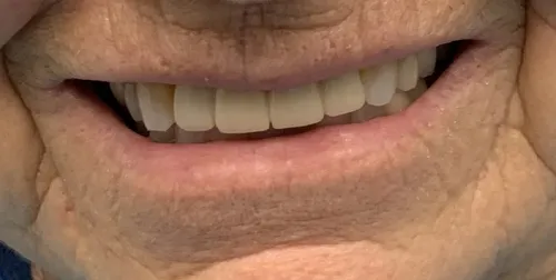After: Smile transformation — implant bridge