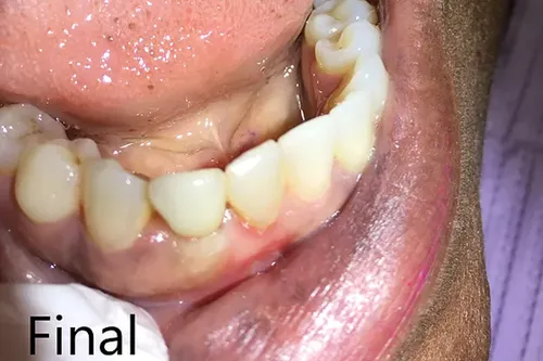 After: Smile transformation — dental implant