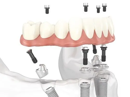All-on-4 dental implants illustration