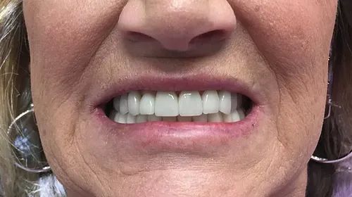 After: Smile transformation — dental implants