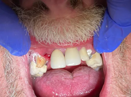 Before: Smile transformation — crowns and implants