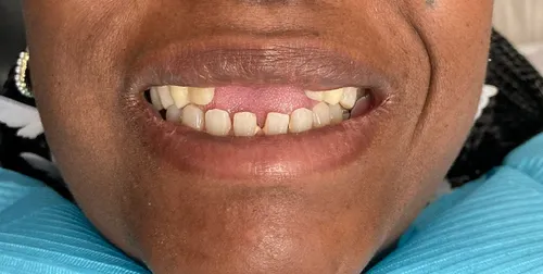 Before: Smile transformation — implant bridge