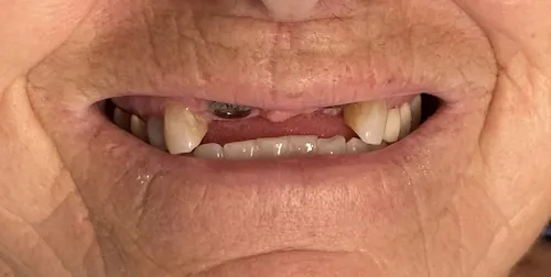 Before: Smile transformation — implant bridge