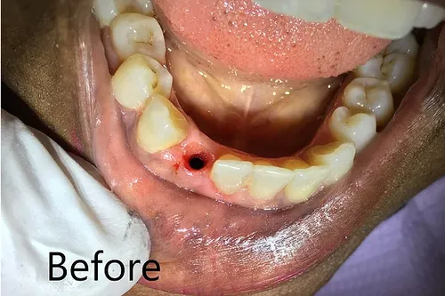 Before: Smile transformation — dental implant