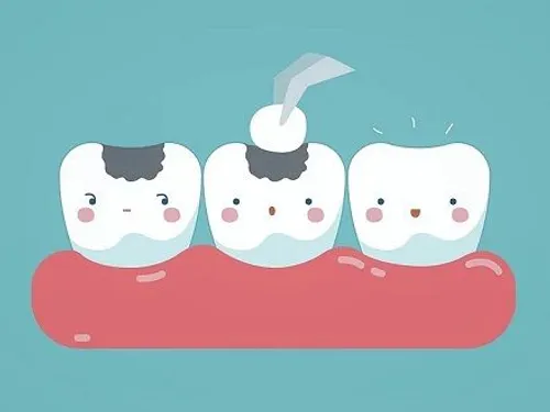 Composite dental fillings at Desoto Dentures and Implants