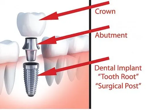 Dental implants at Desoto Dentures and Implants