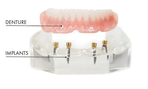 Implant-supported dentures at Desoto Dentures and Implants