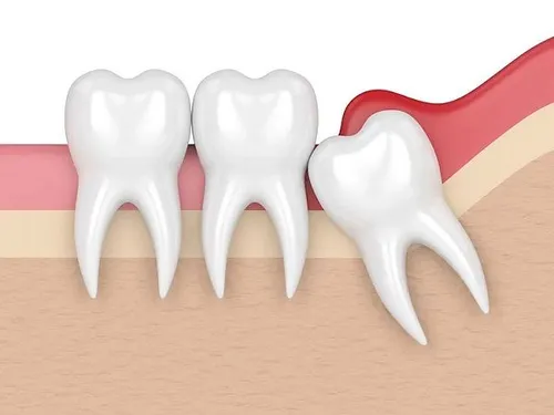 Wisdom teeth removal at Desoto Dentures and Implants