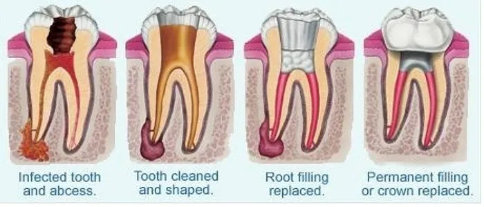 Root canal therapy at Desoto Dentures and Implants
