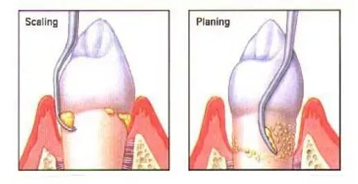 Scaling and root planing at Desoto Dentures and Implants