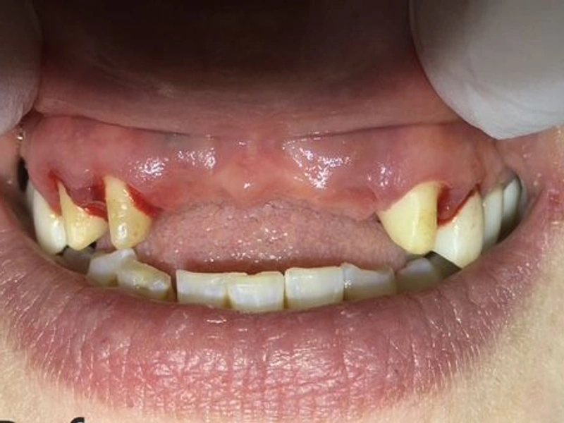Before: Smile transformation — dental implant
