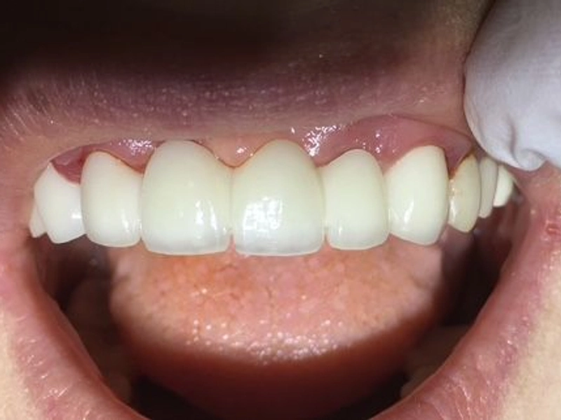 After: Smile transformation — dental implant