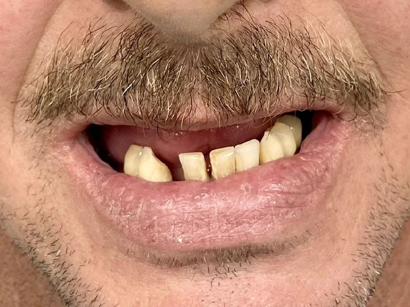Before: Smile transformation — dental implant