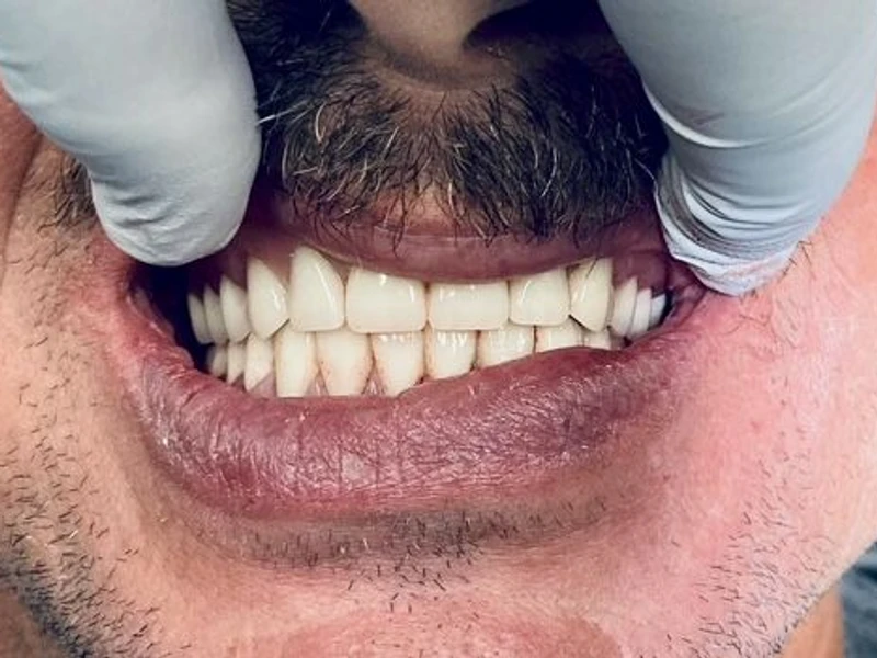 After: Smile transformation — dental implant