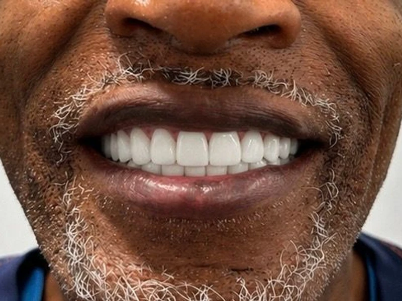 After: Smile transformation — dental implant