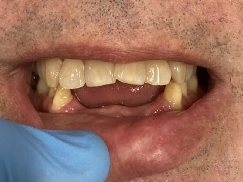 Before: Smile transformation — dental implant