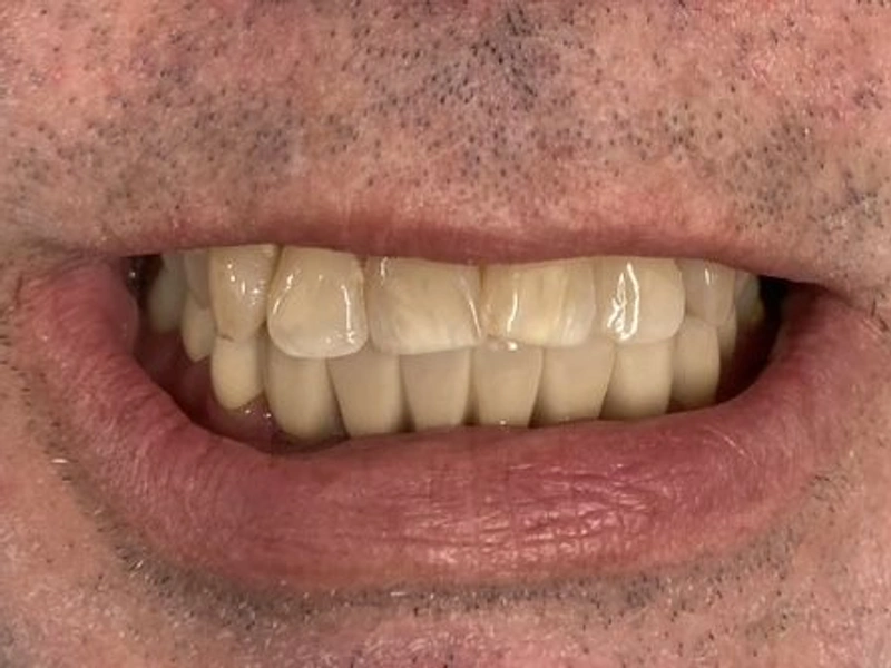 After: Smile transformation — dental implant